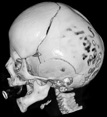 Posterior ve lateral projeksiyonlu, kemik ve yüzey yansıtmalı 3 boyutlu BT