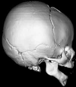 sütürü açık olguda, sağ orbitada ve sağ frontalde
