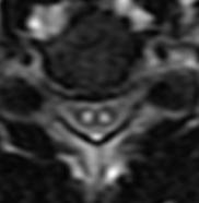 Spinal kord infarktı için patognomonik değildir.