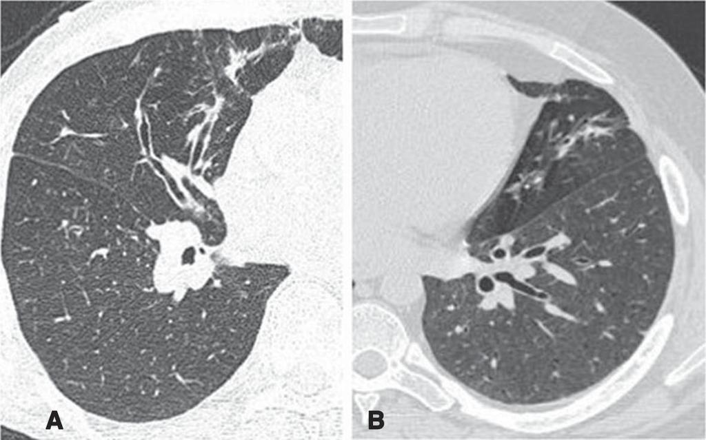 19 yaşında erkek WG olgusu. (A) yüksek rezolüsyonlu BT de sağ orta lobda tübüler bronşiyektazi ve bronş duvarlarında kalınlaşmalar izleniyor, (B) sol lingular lobda hava hapsine bağlı lüsensi artışı.