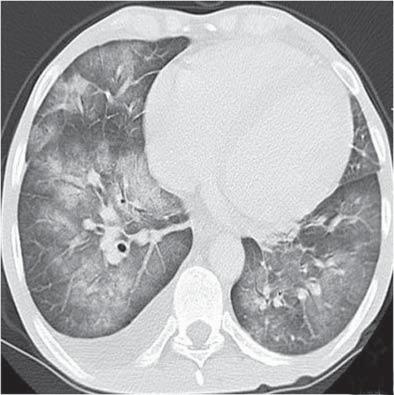 Wegener granülomatozis akciğer tutulumunda bilgisayarlı tomografi bulguları: Resimlerle bir konu KAYNAKLAR 1. Wegener F.
