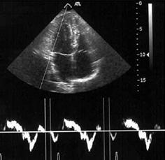 Şekil 1:Apikal dört boşluktan kaydedilen normal doku Doppler görüntülemeye ait ekokardiyografi görüntüsü. 2.