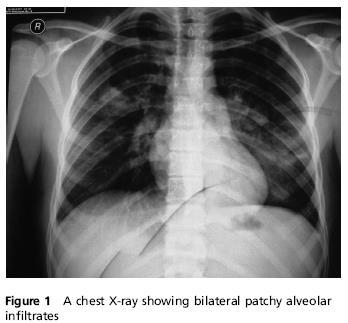 Congo-Crimean Hemorrhagic Fever and Diffuse Alveolar Haemorrhage Doganci L,.