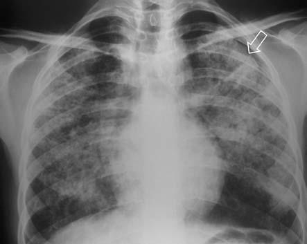 Şahbaz S, İnönü H, Öcal S, Yılmaz A, Pazarlı C, Yeğinsu A, Filiz N, Seyfikli Z. horax were seen in the chest X-ray (Figure 1).