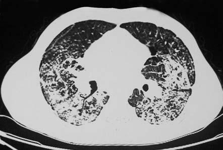 6 in PFT. Acid-resistant basille (ARB) in gastric fluid and tuberculin skin test were negative. Fiberoptic bronchoscopy (FOB) was normal.