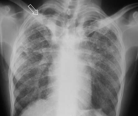 Denim sandblasting and silicosis two new subsequent cases in Turkey bronchial mucosa biopsy. For the differential diagnosis open lung biopsy was performed.