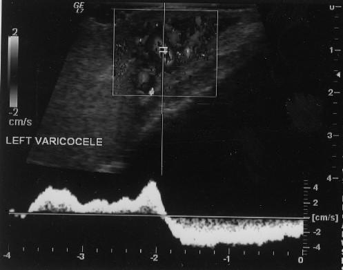 Şekil 1: Epididim kisti. Şekil 2:valsalva ile varikosel öçümü. Şekil 3: Valsalva ile reflü akım.