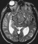 (E) Postoperatif dönemde kontrol MR incelemede, her iki Sylvian fissürde süperfisial siderozis bulgular n n devam etti i dikkati çekiyor.