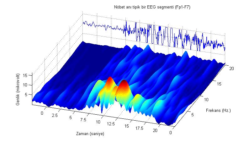 Genlik (mikrovolt) 100 0 Nöbet anı tipik bir EEG segmenti (Fp1-F7) -100 0 2.5 5 7.5 10 12.5 15 17.5 20 0 2.5 Zaman (saniye) İşaretin enerjisi minimum olmuştur Şekil 5.