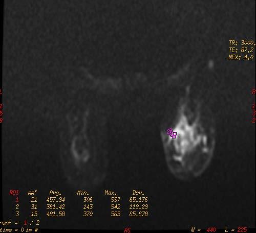 h) b=600 sn/mm² ADC ı) b=800 sn/mm² ADC Olgu-4: 83 yaşında bayan hasta, sağ meme üst dış kadranda,