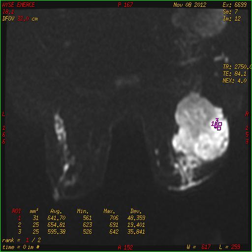 h) b=600 sn/mm² ADC ı) b=800 sn/mm² ADC Olgu-5: 72 yaşında bayan hasta, sağ meme üst dış kadranda, 100x95 mm boyutlu, irregüler kenarlı, lobüle
