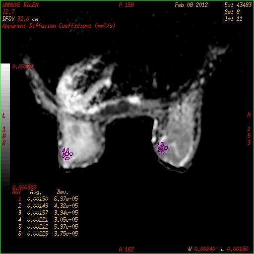 Difüzyon incelemede (d,e,f) lezyon kısıtlılık izlenmektedir.