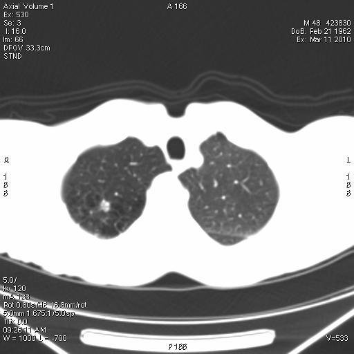 emisyon tomografisi görüntüsü, C-Aksiyal