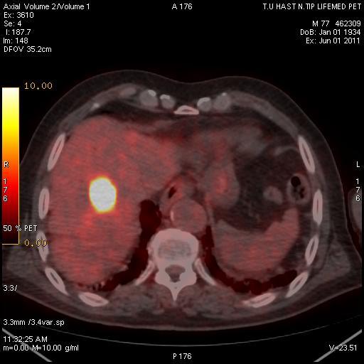 metastaz ve abdominal lenf nodu metastaz : A-Tüm vücut pozitron emisyon tomografisi
