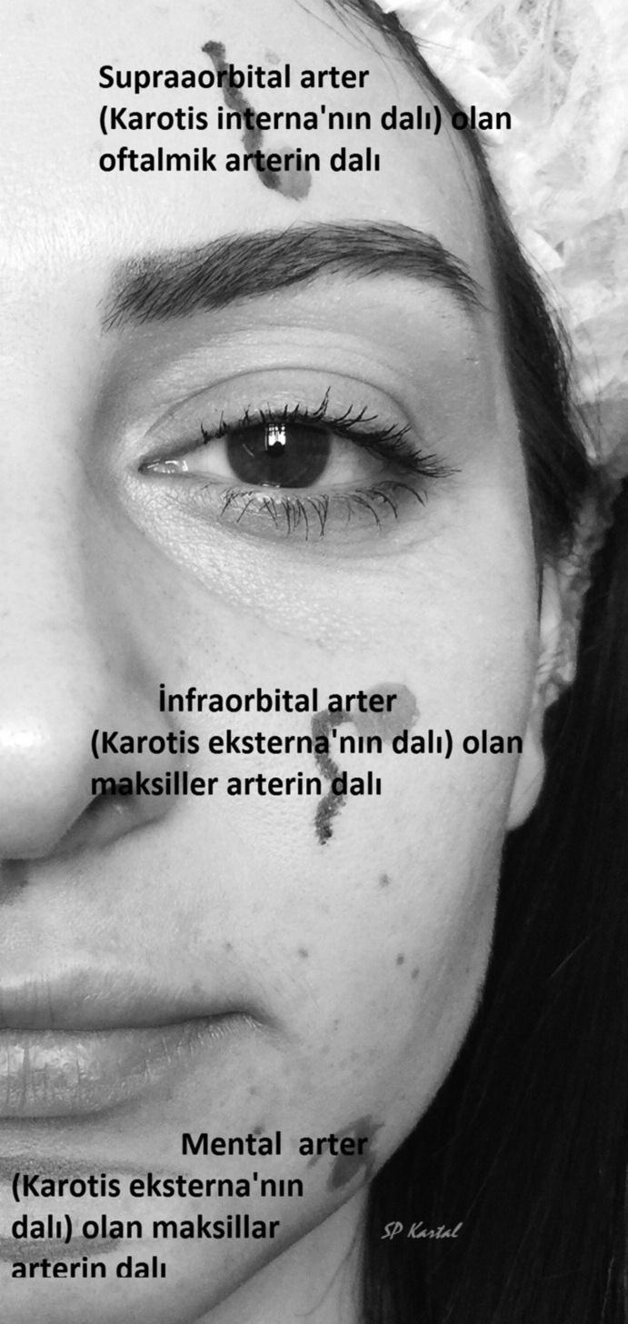 olan maksiller arterin dalıdır. İnferior orbital foramenden yüze çıkar ve orta yüzde transfer fasiyal gulamaarterle anastomozları vardır (Eksternal-Eksternal Karotis Arter Anastomozu).