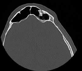 146 Turan et al. Frontal Sinus Osteomas Turk Arch Otorhinolaryngol 2015; 53: 144-9 Resim 1. Koronel ve aksiyel kesitlerde PNS BT görüntüleri Resim 4. Postoperatif 4. ay kontrol PNS BT Resim 2.