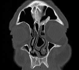 4. ay elde edilen kontrol PNS BT incelemesi görülmektedir. Bütün olgularda osteom dokusu tamamen çıkarılmaya çalışıldı. Osteomun köken aldığı bölge turlanarak nüks oluşumu engellenmeye çalışıldı.