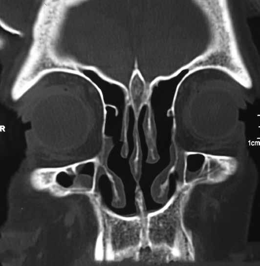 ayında nüks saptanması üzerine hastaya tekrar sağ osteoplastik flep yaklaşımı ile eksternal cerrahi uygulandı. Yedi aylık izleminde nüks saptanmadı.