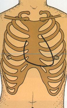 Basis: 2-3. cartilago costalis hizasındadır.