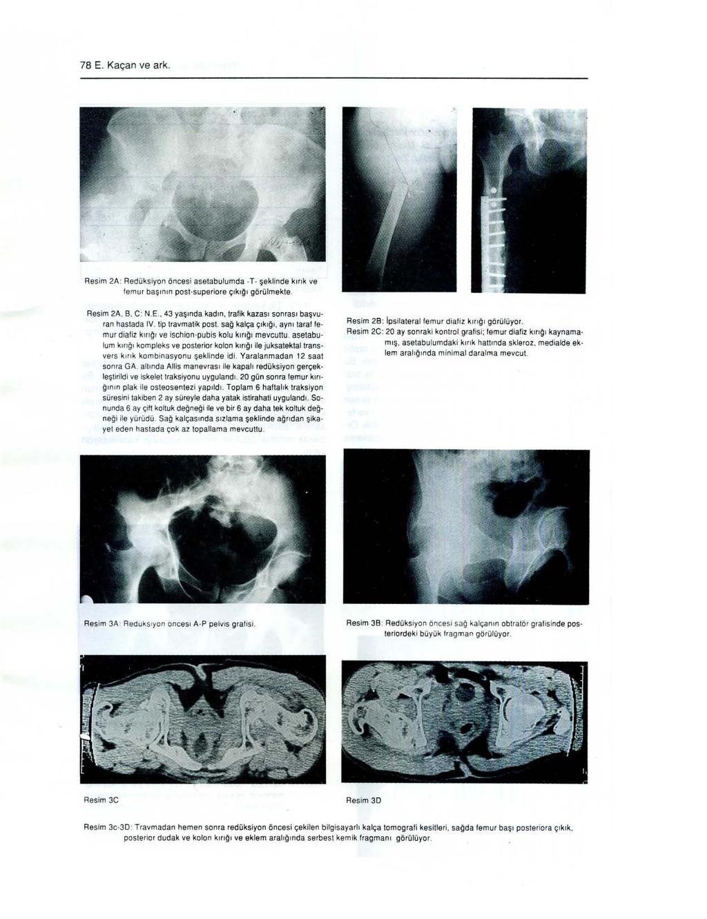 78 E. Kaçan ve ark. Resim A: Redüksiyon öncesi asetabulumda -T- şeklinde kırık ve femur başının post-su pe rio re çıkı~ı görülmekle. Resim 8: ıpsilateral femur diafiz k ı rığ ı görülüyor.