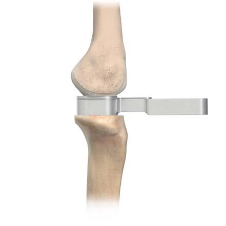 1 mm Ekstansiyon Şimi Şekil 20 Ekstansiyon aralığını kontrol etmek için, bacağı tamamen uzatın