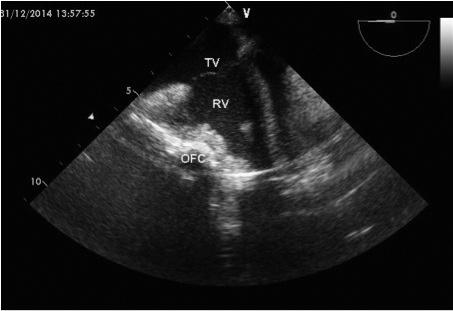 Post LVAD, Outflow kanülünün (OFC) sağ atrium basısı, triküspit yetmezliği. Resim 4. Transgastrik kısa aks görüntü, ileri derece hipokinetik sol ventrikül. Resim 7.