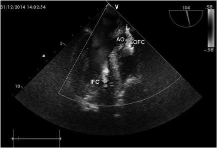 Sternum yine açılarak sağ ventriküle bası yapan outflow kanülü perikard yardımıyla sternum altı dokuya asıldı. Sağ ventrikül değerlendirmesinde RV FAC: %25, hafif TY, RV kısa aks/uzun aks: 0.