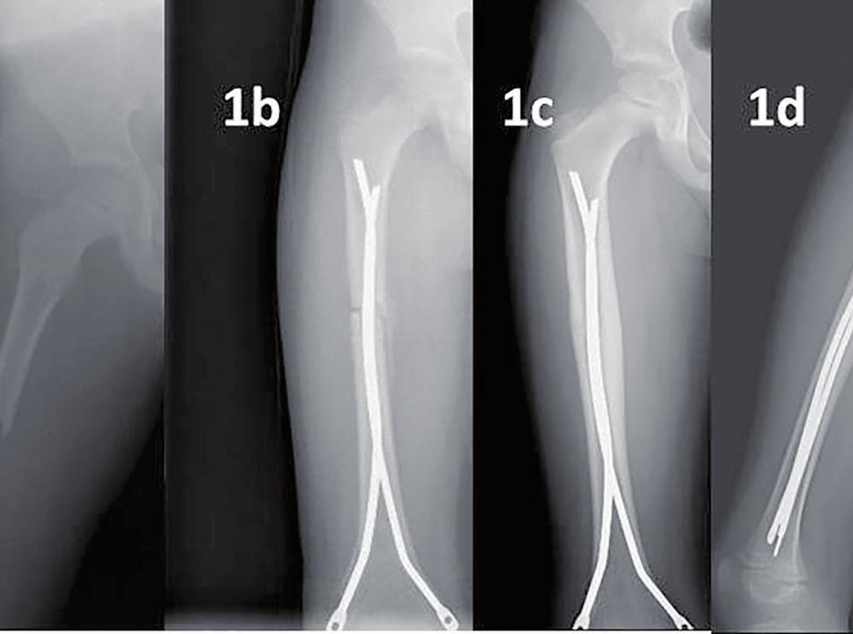 226 Y. Güzel ve ark. Çocuklarda Femur Diafiz Kırıklarının Tedavisi rası ve son kontrolde elde edilen ön-arka ve yan direk grafilerde sagittal ve koronal planda yapılan açı ölçümleri ile belirlendi.