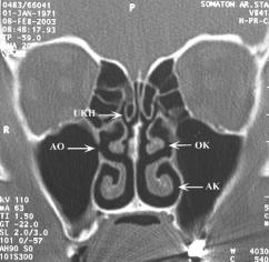 Ça c CA ve ark. Resim 1. Resim 2. Sa maksiller sinüs aksesuvar ostiumu ve buna efllik eden sa maksiller sinüste mukozal kal nlaflma ile bilateral üst konka havalanmas.