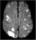 Kardioembolik İnmeler CT-MRI da bihemisferik Kombine