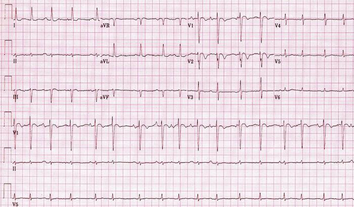 PFO-Aritmi Özellikle atrial aritmilerin neden