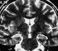 Hipokampusun anatomik s n rlar n n saptanmas nda; hipokampusun baş n amigdaladan ay rmak için yan ventrikülün temporal boynuzunun unkal resesi ve görülebiliyorsa hipokampus baş n n tipik