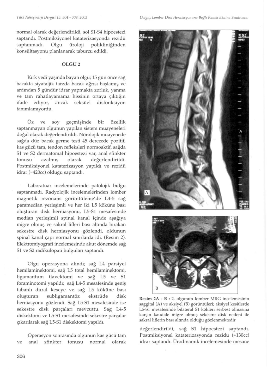 Türk Nörosiriirji Dergisi 13: 304-309, 2003 Dalgiç: Lomber Disk Heniiasyonima Bagli Kaiida Ekiiina Seiidromii: normalolarak degerlendirildi, sol 51-54 hipoestezi saptandi.