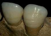 Erişkin iki erkek bireyin mandibula üzerindeki dişlerinde enamel hipoplazi görülmüştür (Şekil-11).