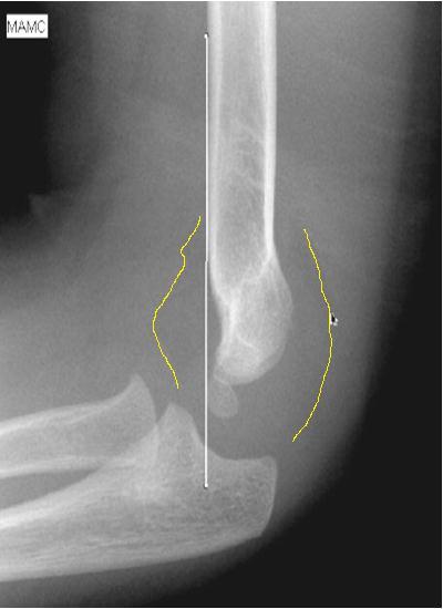 Yağ Yastıkları Anterior Fat Pad Sign: Anterior yağ yastığının ince bir çizgi halinde fark edilmesi normaldir İntraartiküler hemoraji yağ yastıklarını dışarı iter Sail sign (yelken bulgusu) Travmalı