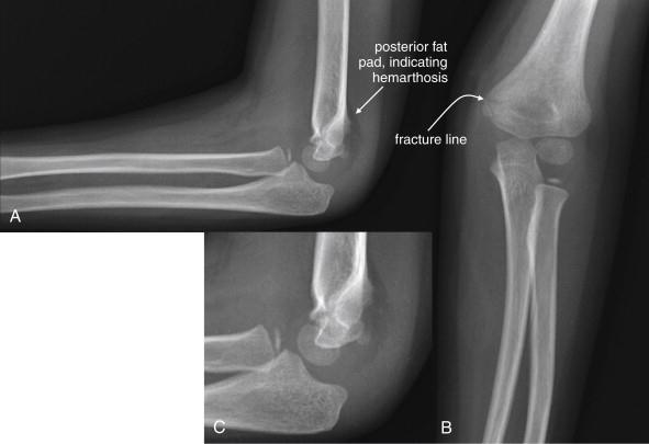 Suprakondiler Humerus Kırığı Çocuklardaki dirsek kırıklarının %60 ı Dirsek ekstansiyonda iken el üzerine düşme