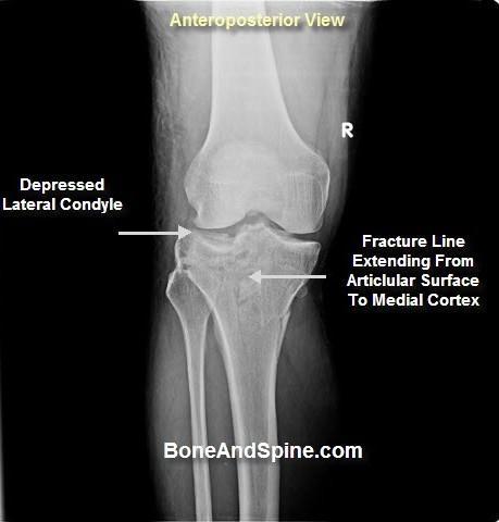 Tibia Plato Fraktürleri Standart diz AP ve lateral görüntülerin sensitivitesi %79 dur Klinik şüphe ya da yetersiz görüntüleme durumunda