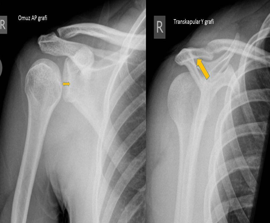 Posterior Omuz Çıkığı YaklaĢık %79 posterior çıkık ilk değerlendirmede