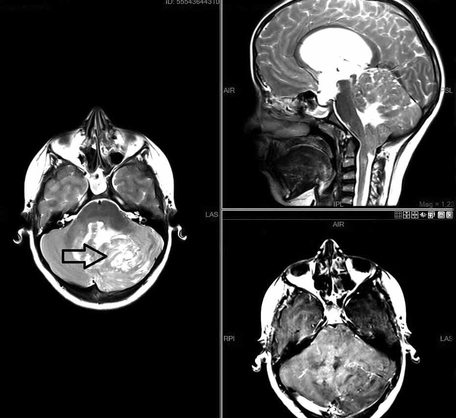 tümörlerde ise özellikle medulloblastoma ile ayırıcı tanı önem taşır.