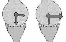 8 Acta Orthop Traumatol Turc Suppl niflli i 0.4-2 cm aras ndad r. [46] Özellikle kord flekli anterior stabiliteyi art r r.