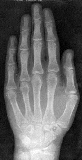 Figure 4: aa, pre-treatment lateral head film, b, posttreatment lateral head film, c, hand-wrist film of 17-year-old male subject treated with activator.