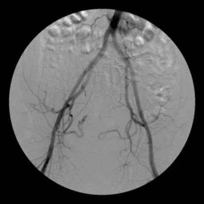 Materyal-Metod Embolizasyon Teknigi Resim 4.