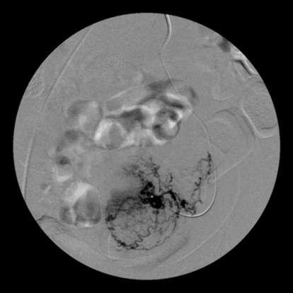 Materyal-Metod Embolizasyon Teknigi Resim 6.