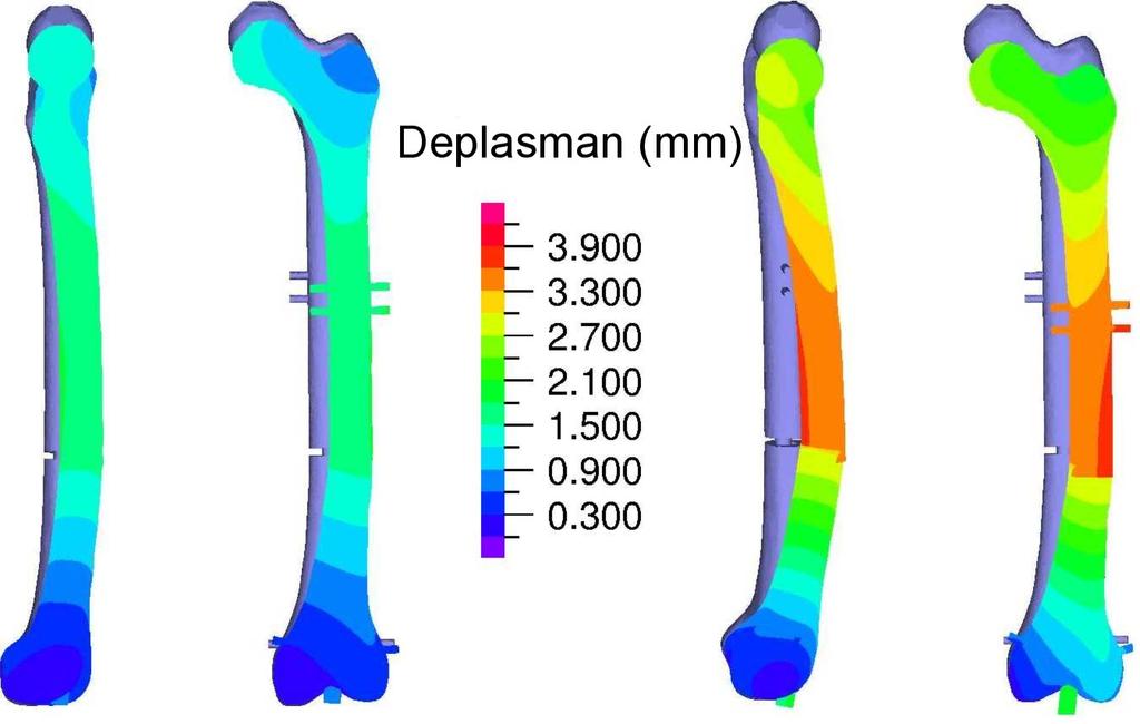 Şekil 4: Yürüme ve basamak çıkma yükleri altında kemik-implant yapısındaki yer değiştirme dağılmları.