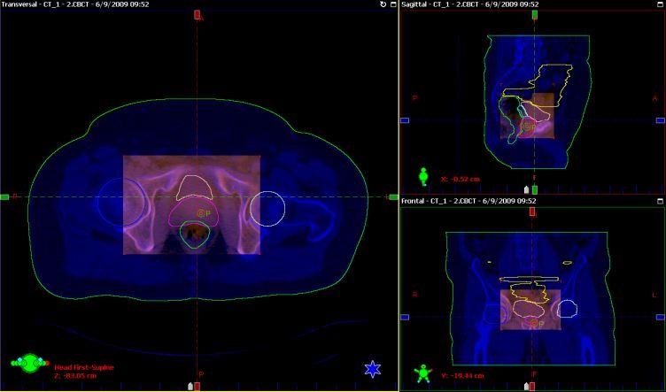 RTT1 RTT2 RTT3 RTT4 CBCT RDpre(cm) RDpost(cm ) RDpre (cm) RDpost