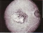 Görme keskinli i de erlendirilmesinde hastalar n k rma kusurlar düzeltilerek, ETDRS (Early Treatment Diabetic Retinopathy Study) taraf ndan gelifltirilen görme keskinli i efleli kullan lm flt r.