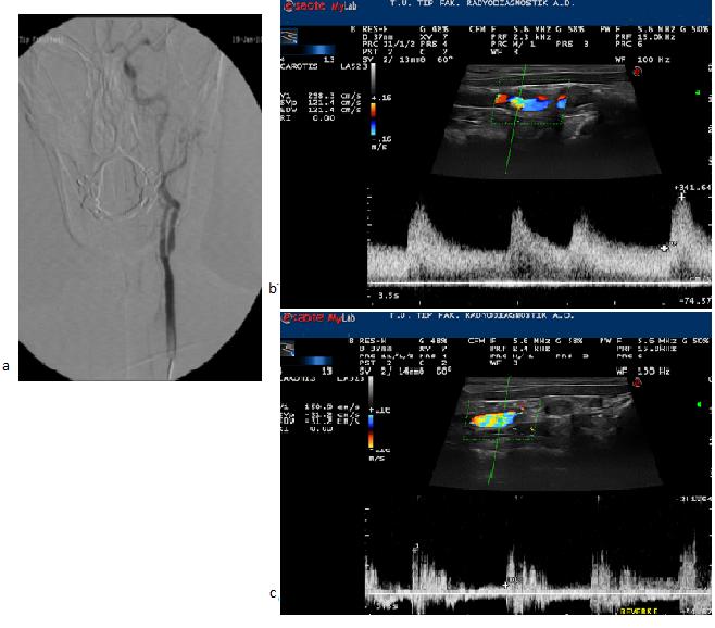 Şekil 4. 64 yaşında erkek hastanın; a. Anjiyografi tetkikinde sol internal karotis arterinde %90 darlık, b.