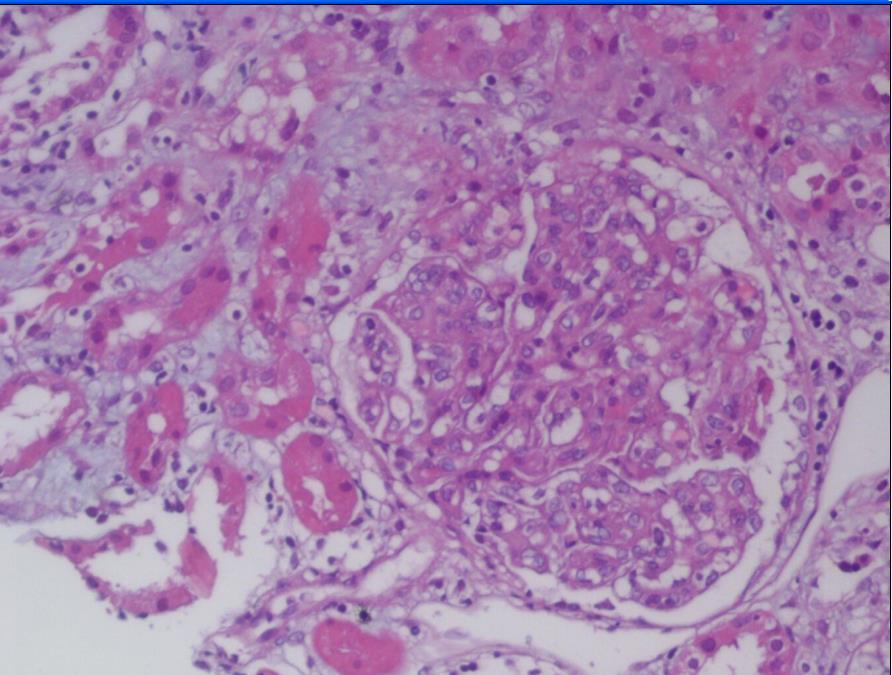 OLGU 1 Renal biyopsi sonucu: HIV ile ilişkili nefropati olarak sonuçlandı HIV direnç testi ve HLA B5701 testi istendi Hastada PPD tekrar edildi.