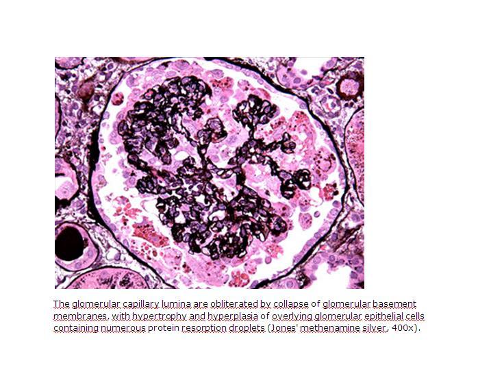 HİSTOPATOLOJİK BULGULAR HIVAN collapsing fokal segmental glomerulosklerozisle (FSGS) karakterizedir Renal tübüllerin mikrokistik