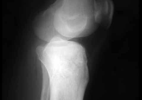 212 TOTBİD Dergisi Şekil 2. Soğan zarı görünümü ile Ewing osteosarkomu ile karışan subakut osteomiyelit olgusu. semptomlar oldukça azdır bu nedenle tanı genelde geç konulur.